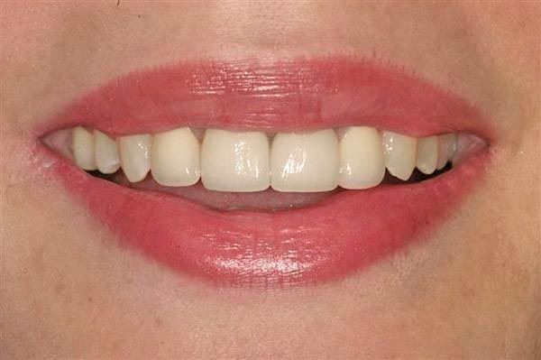 image of after restoration