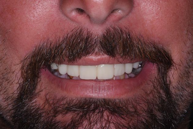 patient with a complete smile after dental implants